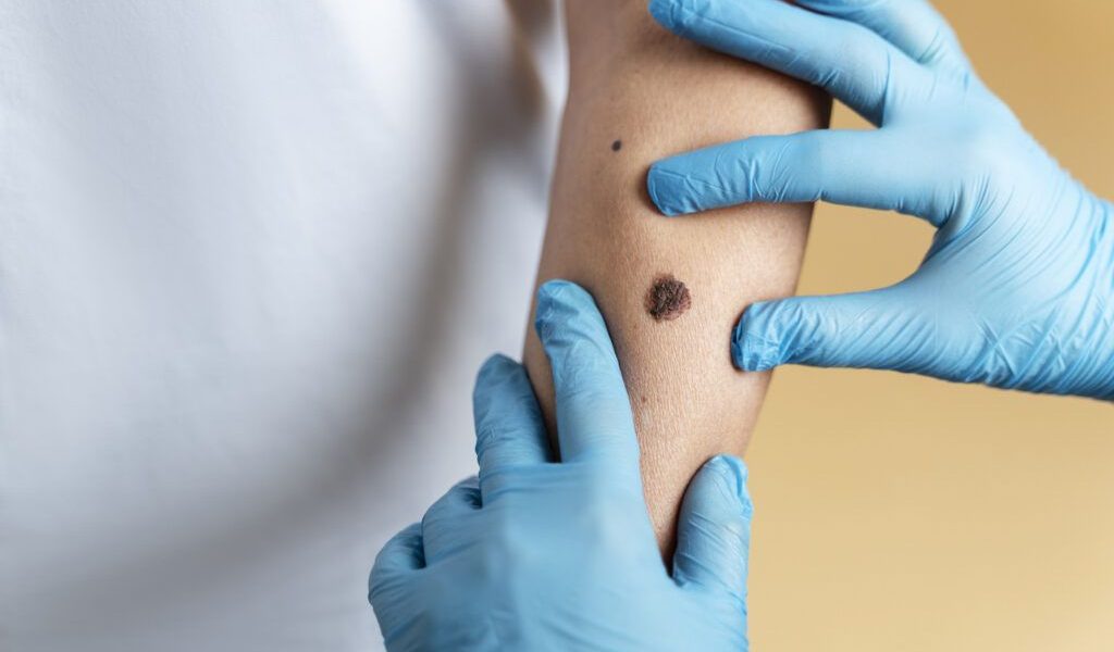 O femeie de 37 de ani din Anglia a murit din cauza unui melanom, cancer de piele extrem de agresiv, după ce afecțiunea a fost ignorată inițial