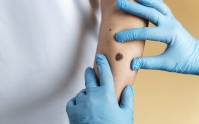 O femeie de 37 de ani din Anglia a murit din cauza unui melanom, cancer de piele extrem de agresiv, după ce afecțiunea a fost ignorată inițial