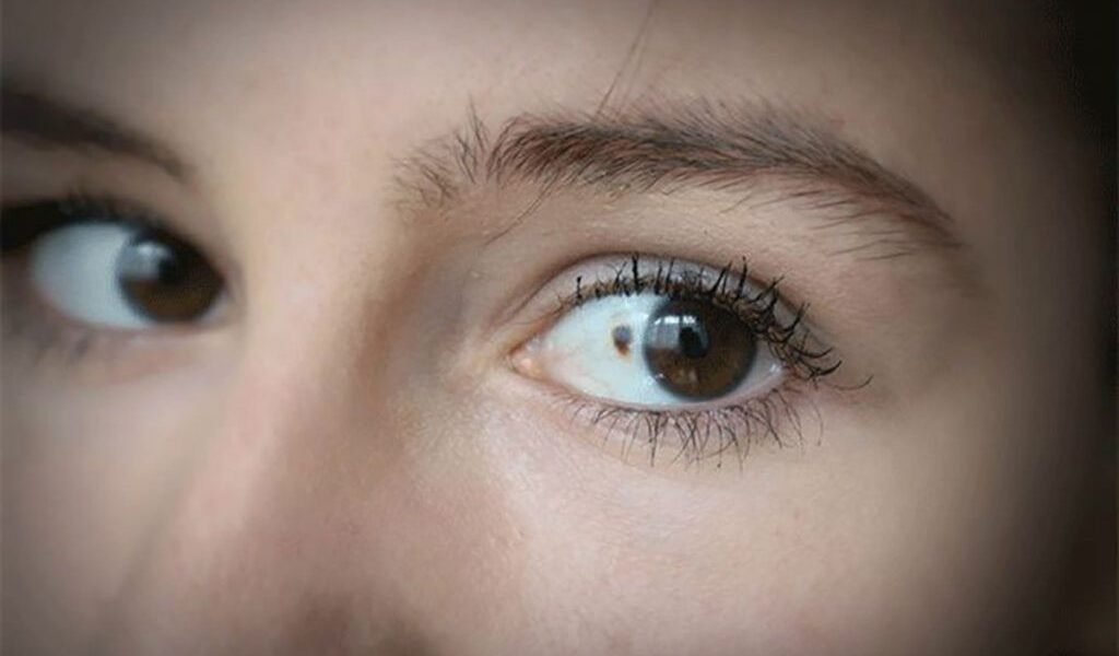 Atenție: 11 semne subtile de cancer care apar în ochi, fără să le vezi!