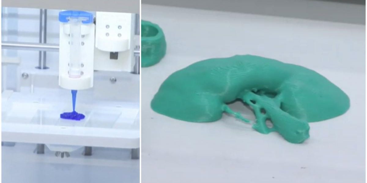 Rinichi „printat” la București: Medicina din România face minuni