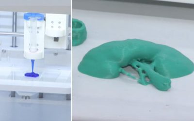 Rinichi „printat” la București: Medicina din România face minuni