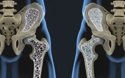 Nou tratament revoluționar: Oase mai puternice, chiar și în osteoporoză