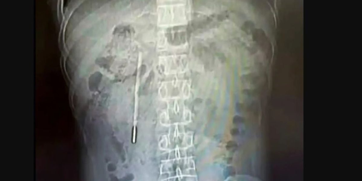 Termometru înghițit de un copil chinez: Medicii, uimiți de ceea ce au găsit