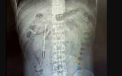 Termometru înghițit de un copil chinez: Medicii, uimiți de ceea ce au găsit