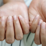 Probleme grave anunțate de UNGHII: Ce sunt „unghiile Terry” și bolile lor