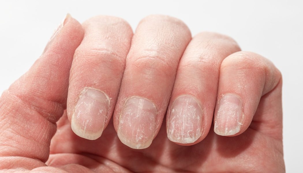 Unghiile, oglinda sănătății: Ce boli grave pot trăda