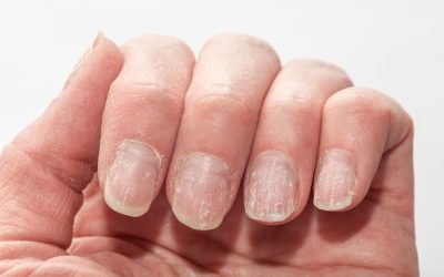 Unghiile, oglinda sănătății: Ce boli grave pot trăda