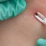 Sindromul Alpha-Gal: Boala declanșată de căpușă, de la mușcătură la inf