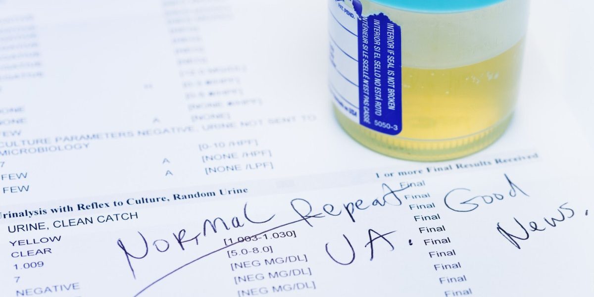 Test Urină: Depistează 9 din 10 Caze de Cancer Vezical